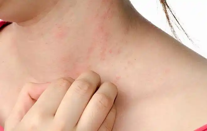 00后女生脖子长菜花查出hpv男人4个行为要拒绝