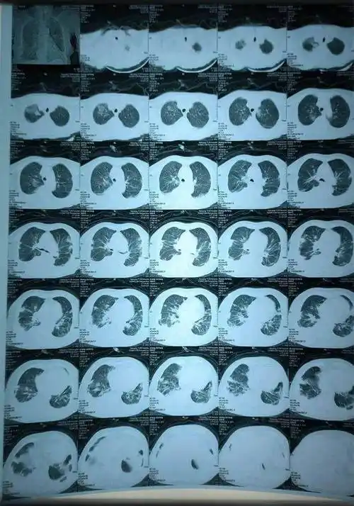 治疗前两肺炎症较重治疗前大量胸腔积液内三科主任李汉颖带领团队精心