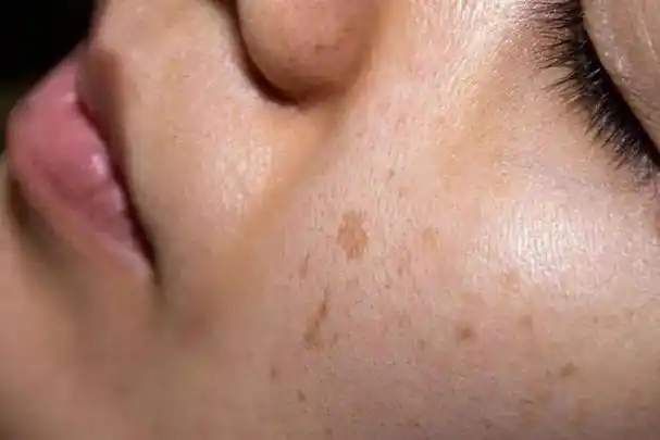 人为什么会长老年斑?涂牙膏,维生素e能去除老年斑吗?涨知识了