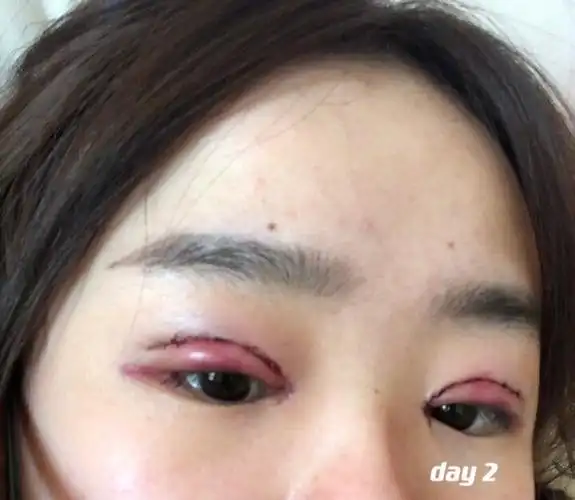 全切开眼角1-7天恢复情况,最后一张是初眼.
