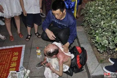 8岁的烧伤男孩小羽与父亲在乞讨手术费用