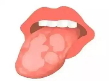 小孩地图舌有什么办法吗?