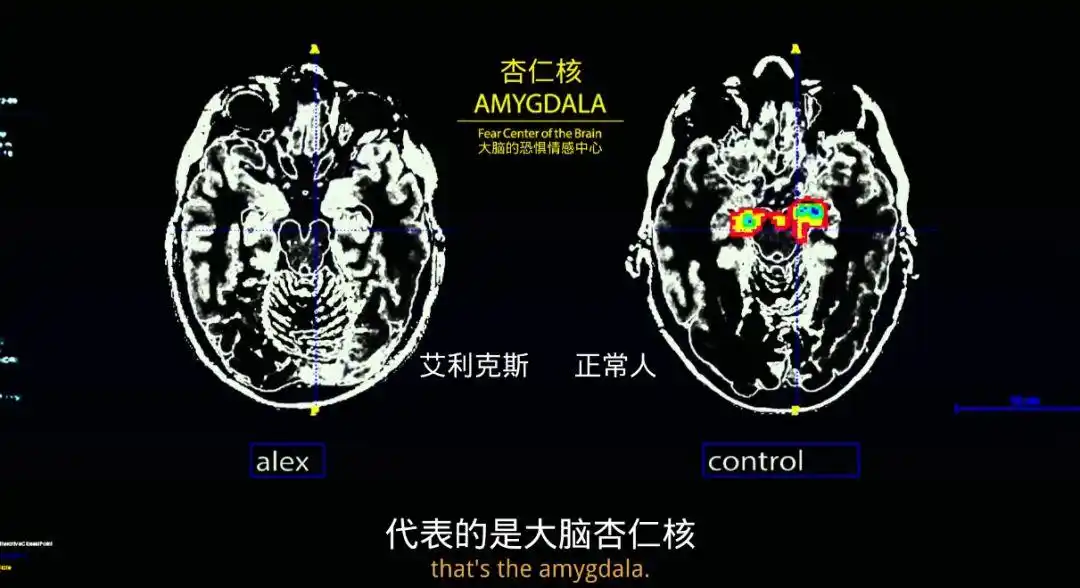 这说明他的杏仁核能接受 更高程度的刺激.