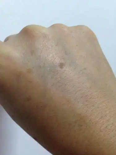 看图不是很清楚,建议多角度拍那个皮损的高清照,需要考虑扁平疣可能