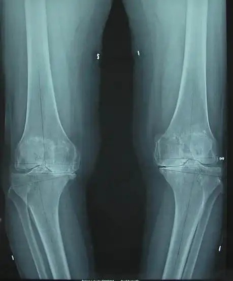 5.0 nexgen lps-flex人工全膝关节表面置换的疗效观察