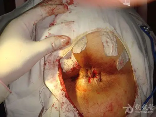 大家看看这个环形混合痔怎么做