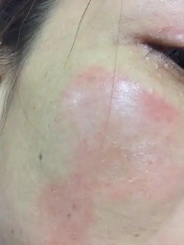 脸上过敏,红肿,很痒很痒,然后洗脸摸着毛毛的,掉皮的样子.