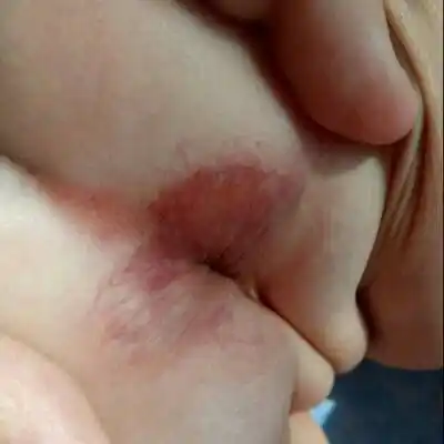 六个月孩子屁股这样的,有没有知道的,急急急!_宝宝树