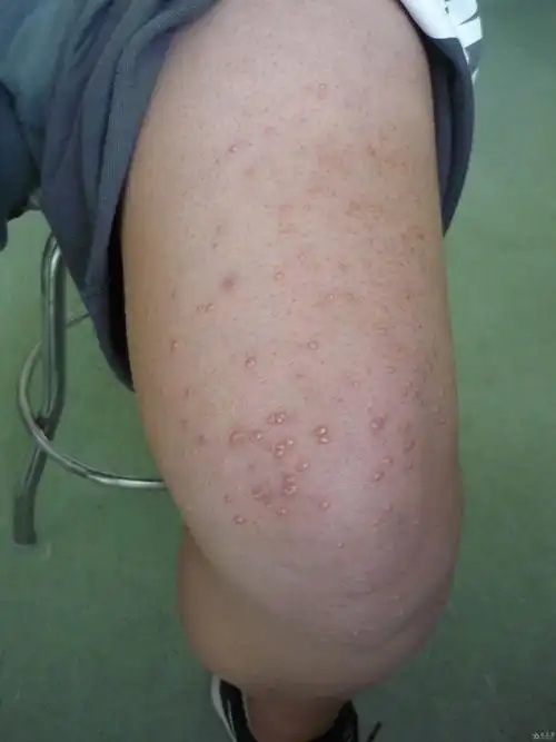 典型病例黄瘤病