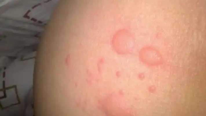 男性一期梅毒图片49