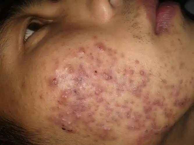 可以帮我看看这个痘痘是不是湿热引起的?