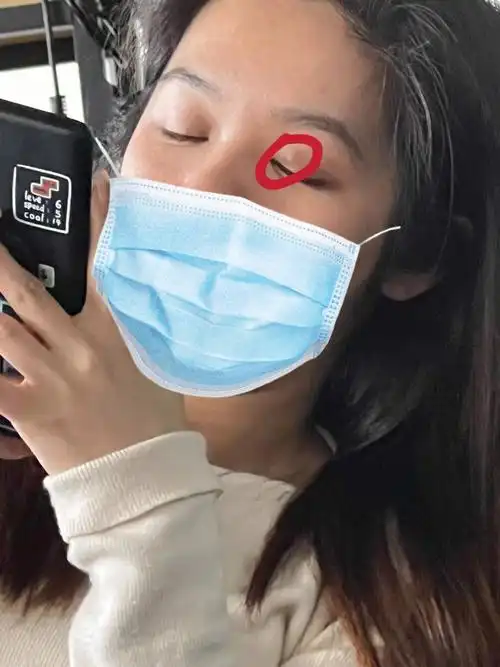 自治治愈了我的孕期霰粒肿