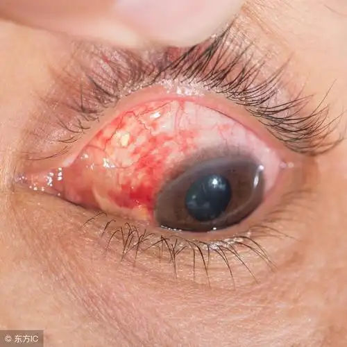 眼科李苹:冬天应该预防的六种眼科疾病!_眼睛