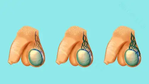 较正常侧的阴囊位置较低,睾丸表现为下垂状态,尤其是活动后更为明显