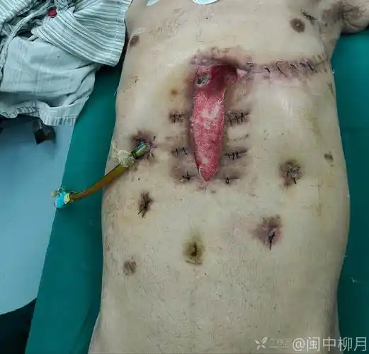 求助胃癌开腹术后切口感染修复