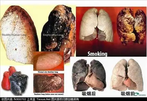 吸烟者的肺(图片)