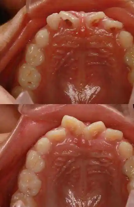 儿童早期矫正之上唇系带