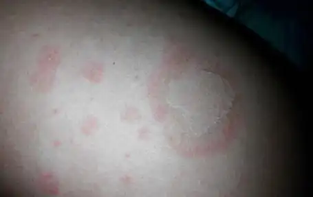 花斑癣图片花斑癣该怎么治疗会传染吗