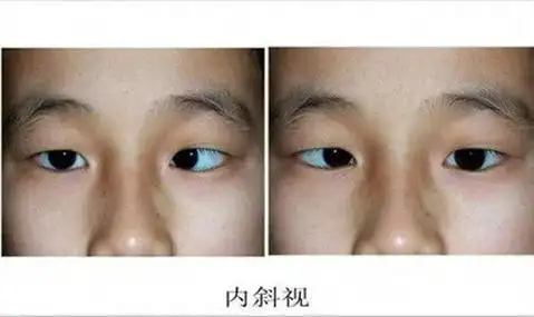 【名医名科】14岁孩子突然得了"斗鸡眼"!这种行为,请及时制止!