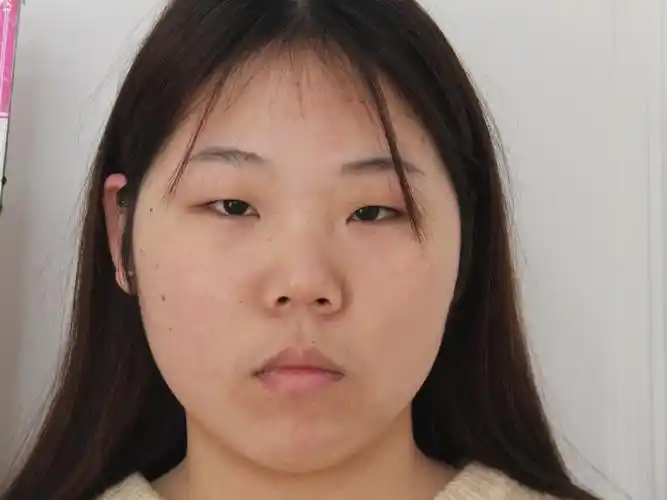 爱美者术前肿眼皮,上眼皮脂肪多,内眦赘皮严重,眼间_圈子-新氧美容