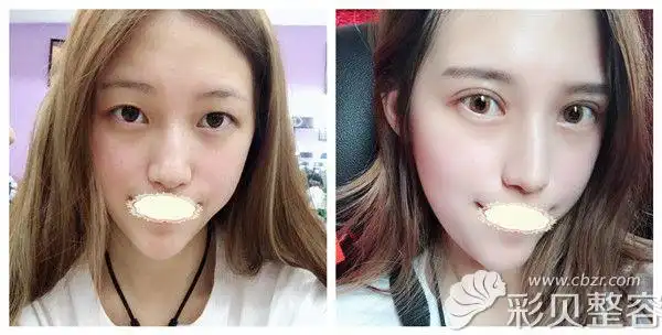 罗秋雄主任全切双眼皮 开内眼角眼部综合术后对比图