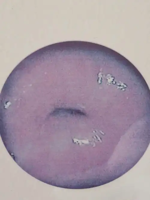 宫颈糜烂莫惊慌,治亦观察需辨别