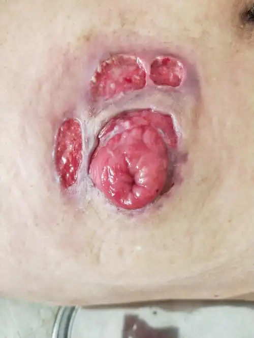 有所好转,创面出现这种粉色,触之易出血,说明有新生的肉芽组织生长