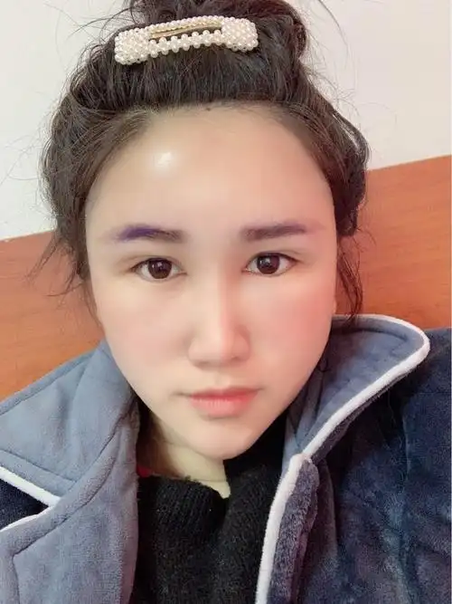 第五天了视觉上脸肿的胖了至少十斤啊只希望能快点