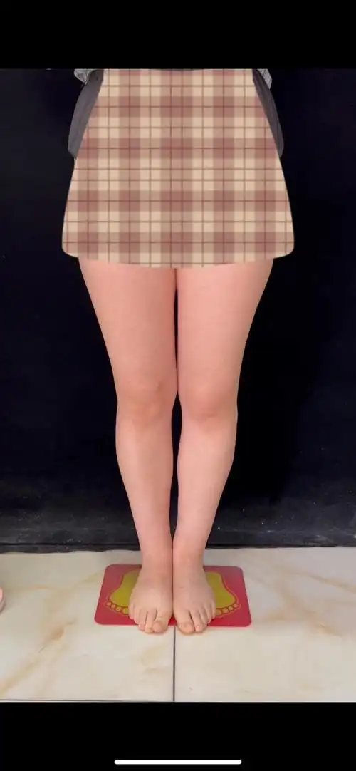 形体管理|直腿术能矫正o型腿或x型腿等不好看腿型吗?