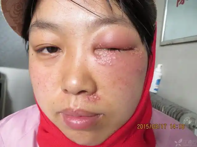 【请教】大家看看是带状疱疹还是单纯疱疹?