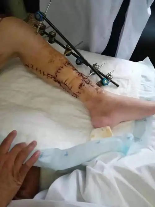一例开放性粉碎性胫腓骨骨折的治疗