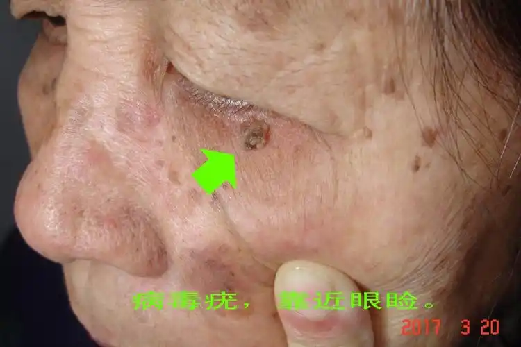 下眼皮疣冷冻一次治愈