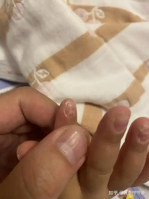 女儿指甲坑坑洼洼的不知道是什么问题?请教各位