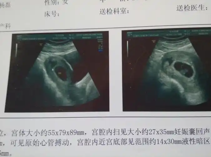 谁会看孕囊看男宝宝女宝宝哦,嘻嘻,我怀孕7周 4