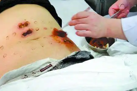 杨浦区一女子被"模特身材管家"减肥仪电死