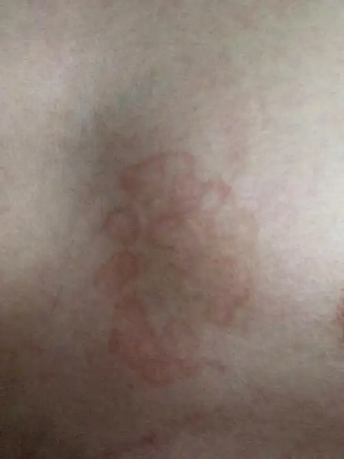 胸前皮肤上有一块红斑(不是很明显),一年多了,不痒不痛.