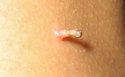 丝状疣一般有哪些症状得了丝状疣该如何护理