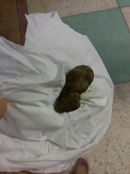 自从喂稀饭了就拉这样的屎,一天拉一粒,硬硬的,超臭,这样正常吗?