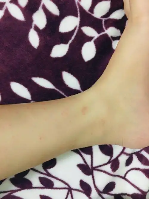 被螨虫咬怎么办