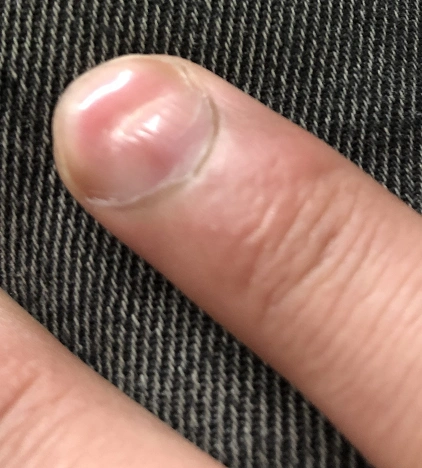 指甲凹陷什么原因?需要看医生吗?