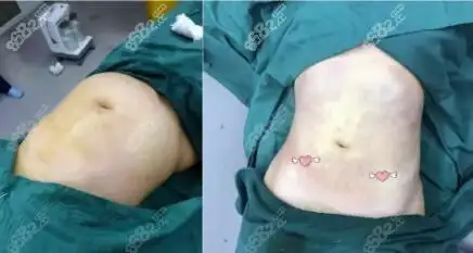 5g天使光雕吸脂瘦腰腹真人前后对比案例照