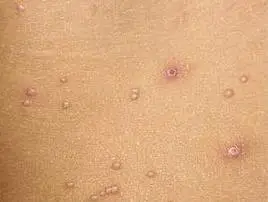 传染性软疣至于感染梅毒,淋病等性病的概率,其实极低极低.