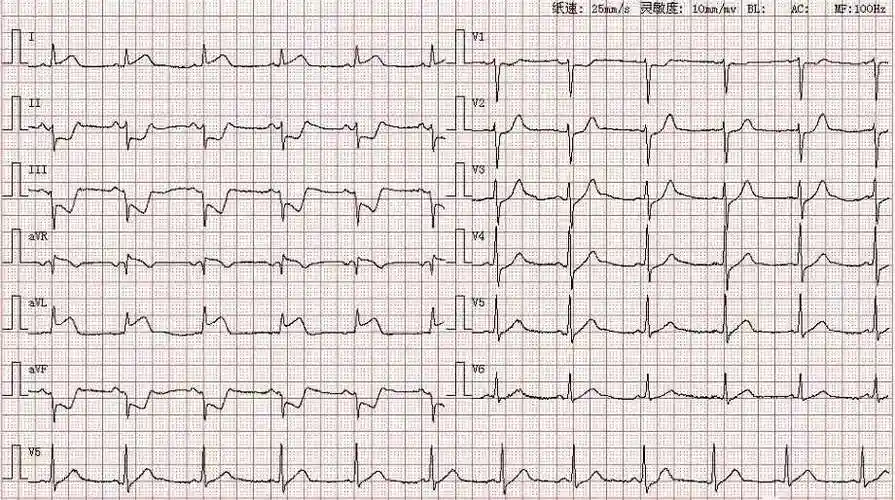 每天一份心电图