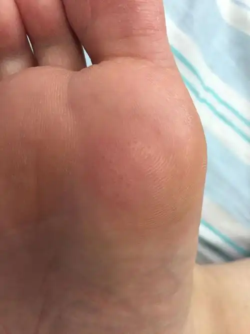 脚掌一段时间皮下就会起这种疙瘩,很痒,请问是脚气吗?该怎么治?