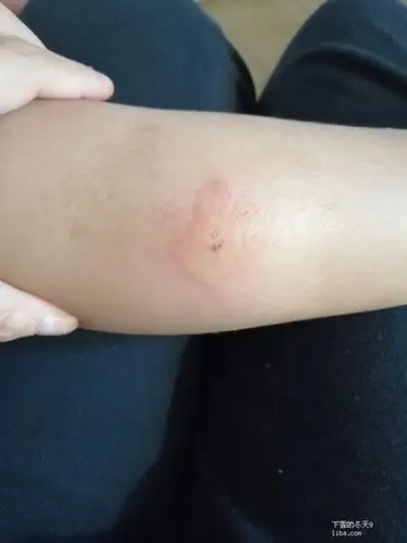 主题:晚上儿子腿被不知名的虫子咬了,什么药管用啊?