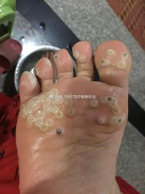 跖疣治疗 v:k779918522