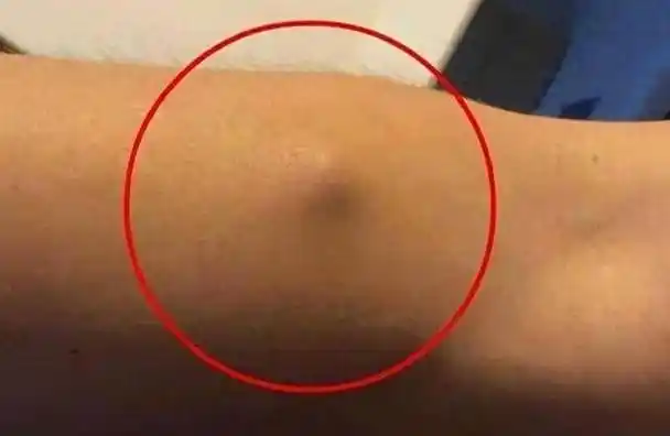 身上长"脂肪瘤"究竟要不要切除?不妨听听医生的说法,涨知识了