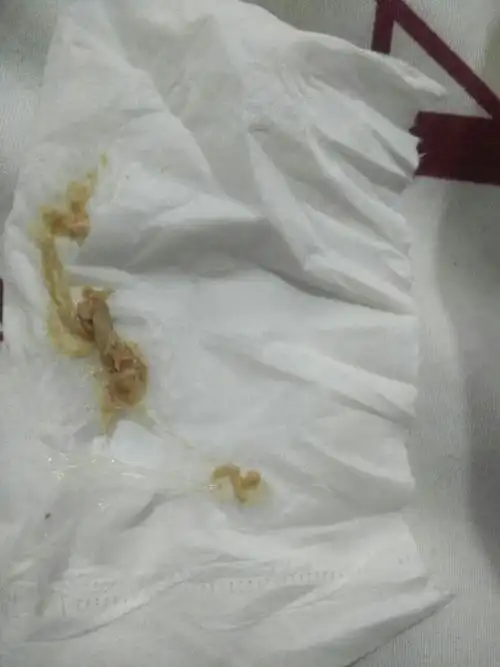 我是宫颈糜烂,看排出的毒素是不是很恶心