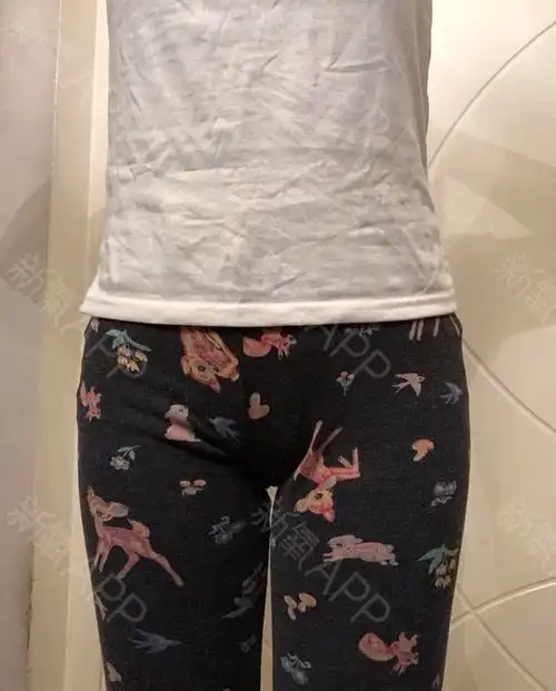 三个月了,腰部左右有些不对称[:5]疤痕还在,什么_圈子-新氧美容整形