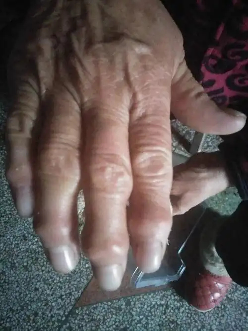 手指骨节变大有时有点疼痛是什么病,怎么治疗